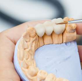 Photo of Dental Bridges