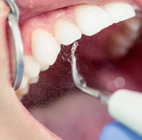 Periodontal Treatment Photo