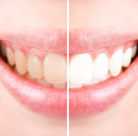 Before and after teeth whitening photo
